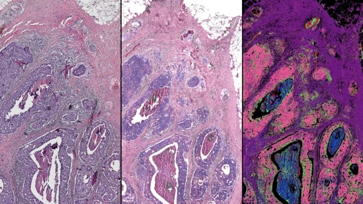 Breast tissue biopsy