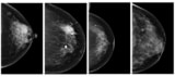 Example mammograms