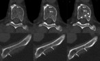 Lytic bone lesions in a multiple myeloma patient