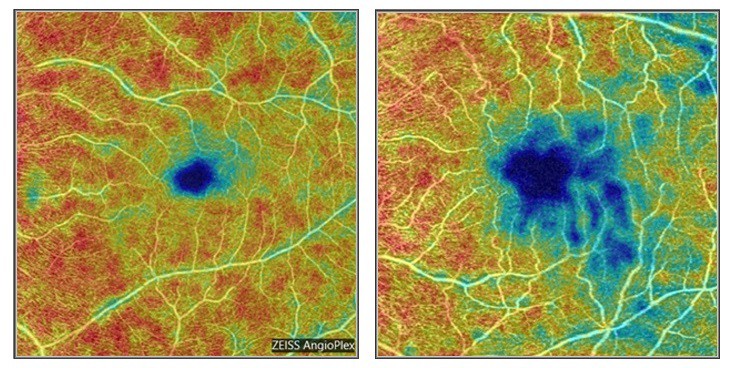 OCT angiography