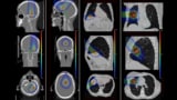 Proton minibeam radiation therapy plans